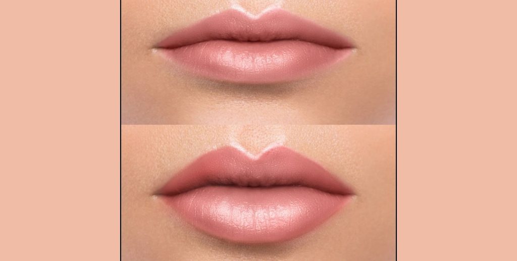 Før/etter bilde - Lip fillers.