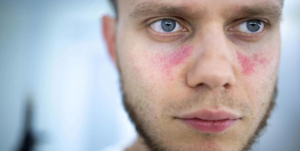 Bilde av person med lupus.