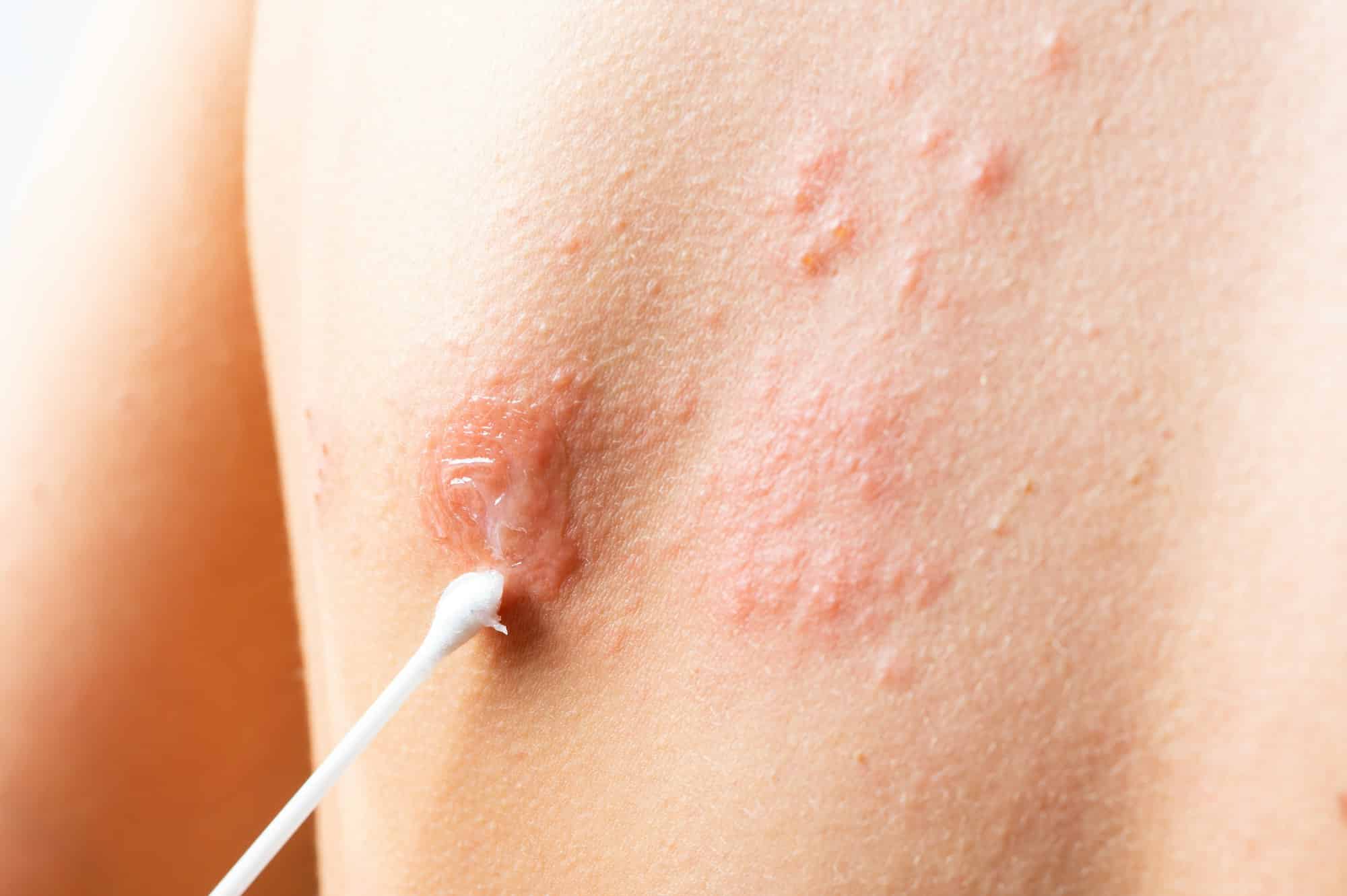 Skin infected Herpes zoster virus. Herpes Virus on body. urticaria rash