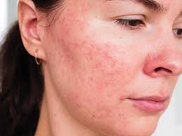 Perioral dermatitt på en eldre dame 2