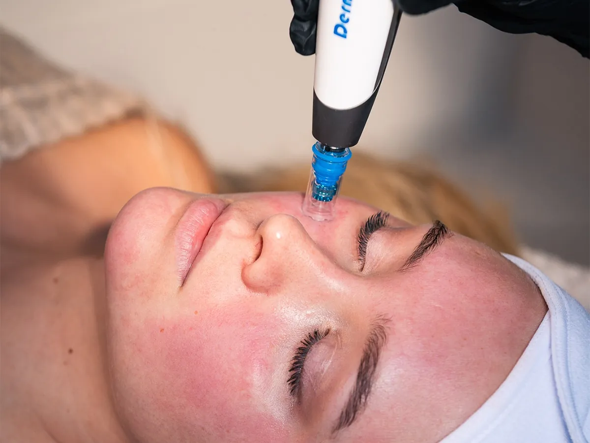 Dermapen + kjemisk peel