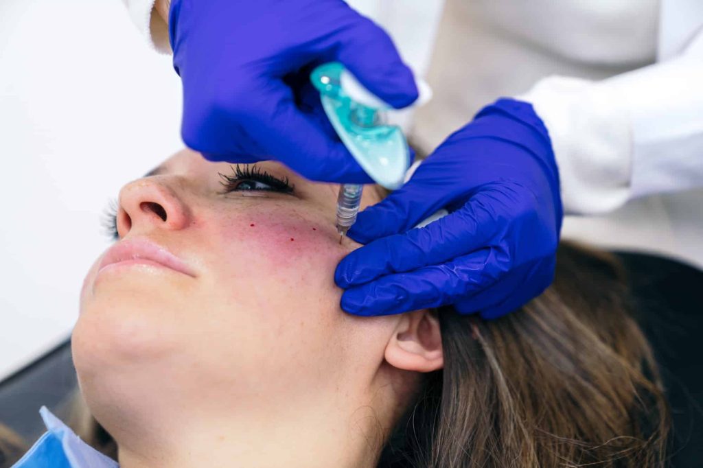 Aesthetician Injects Hyaluronic Acid for Chin Enhancement Procedure