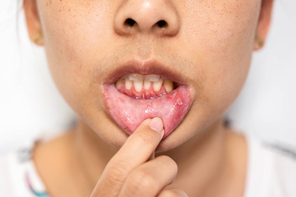 Asian woman have Aphthous ulcer or Canker sore on mouth at lip