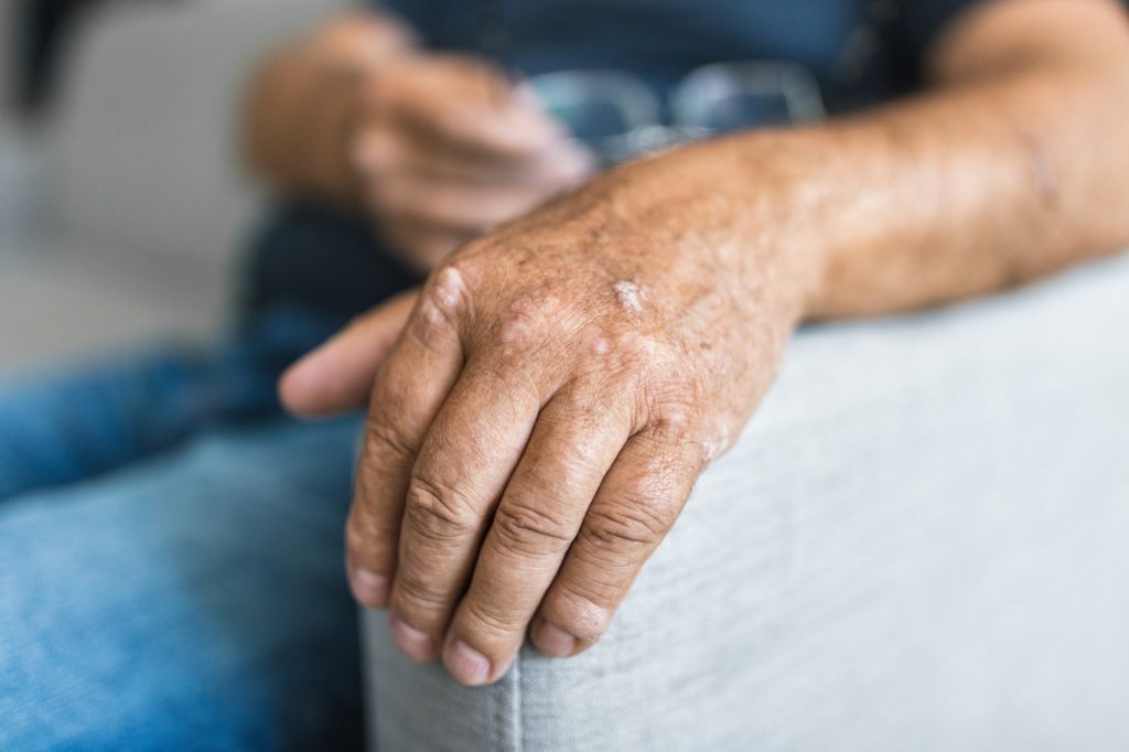 En eldre mann med psoriasis på hendene.