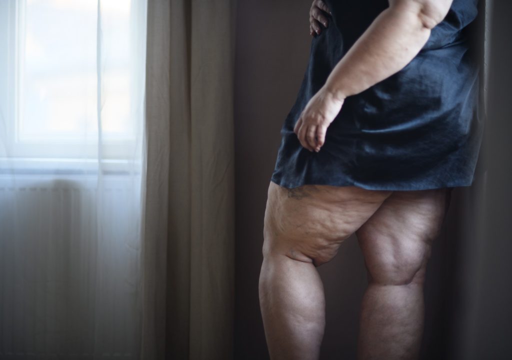 Fat woman with cellulite on her legs, cut out