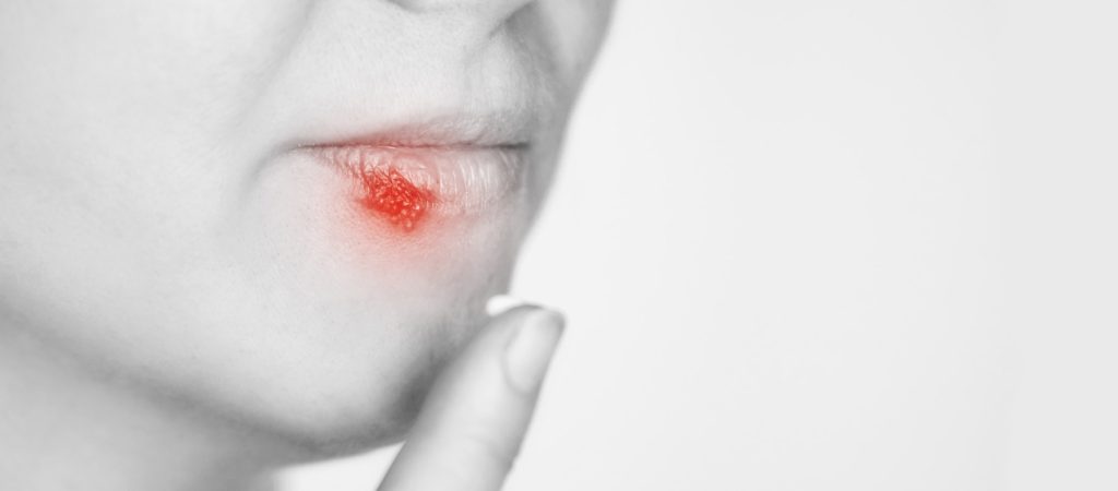 Dame med herpes i leppene. Hun har fingeren nærme, fordi hun skal påføre krem. Dette er en type nuppete hud.