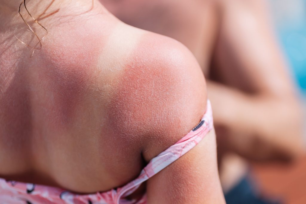 red back of a girl with a sunburn from poor sun protection