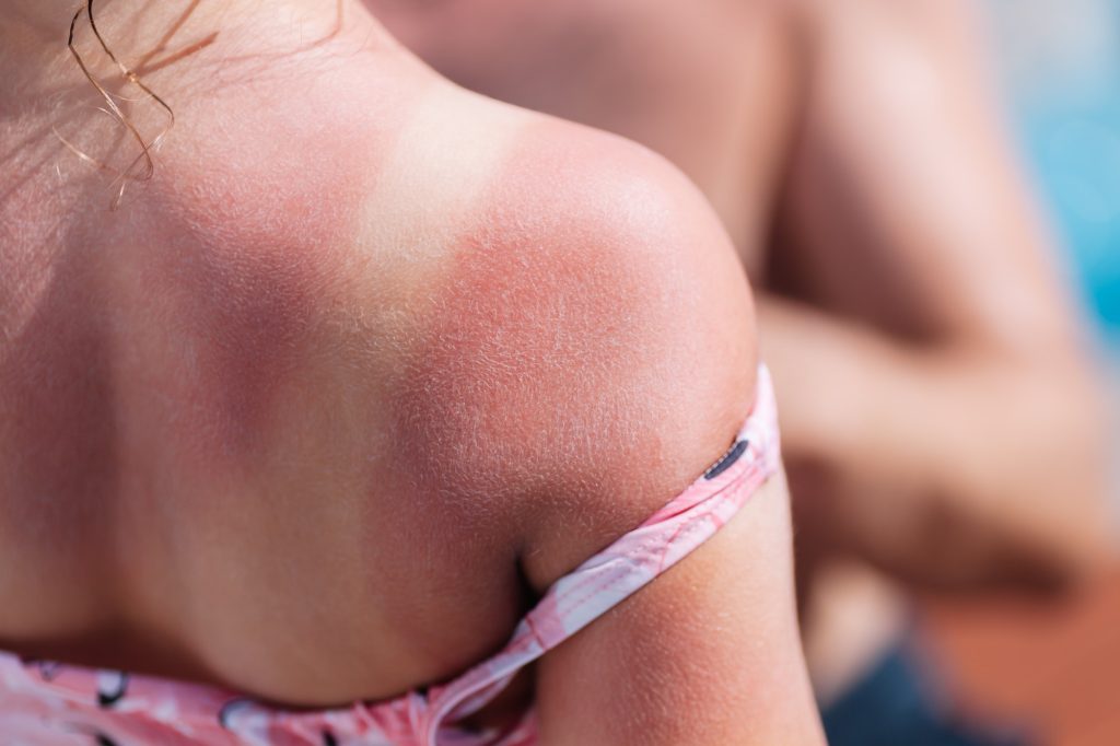 En kvinne er solbrent, bildet er tatt mot ryggen slik at du kan se skillet mellom bh og rygg.