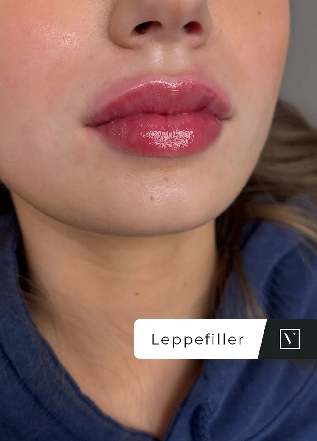 Leppefiller med Restylane