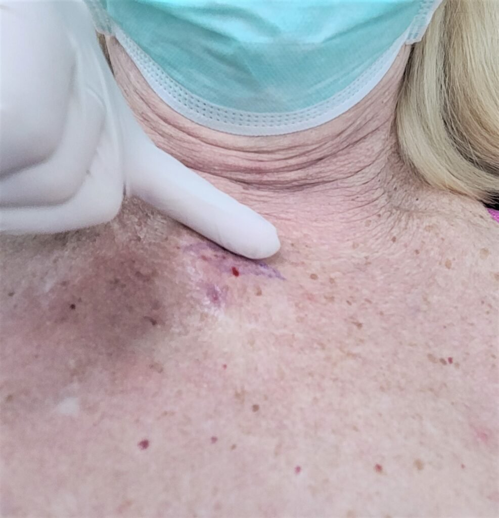 MELANOMA! Older Caucasian Woman with Melanoma Skin Cancer Being Treated by Dermatologist!