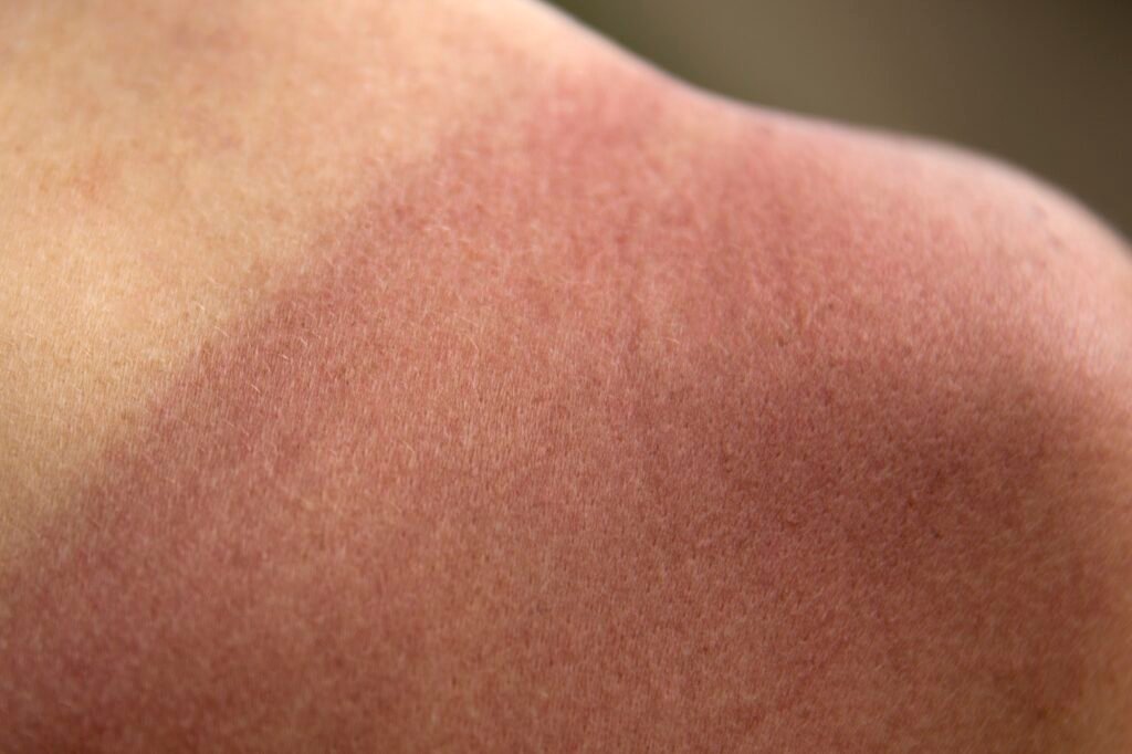 Solbrent hud identifiseres som et hudforhold i en hudanalyse