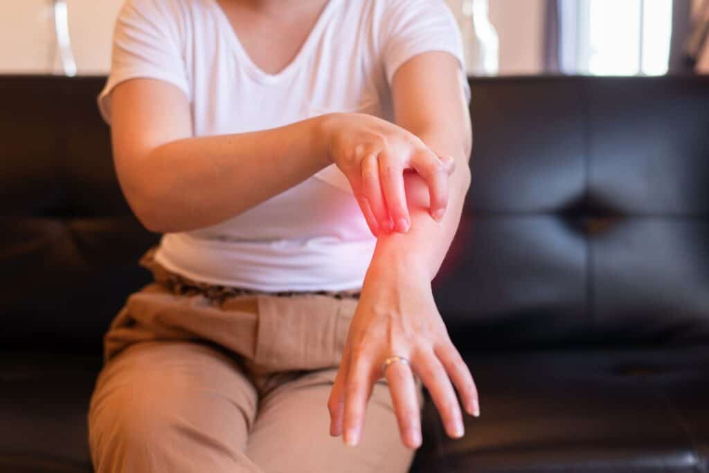 Woman with rash or papule and scratch on her arm from allergies,Health allergy skin care problem