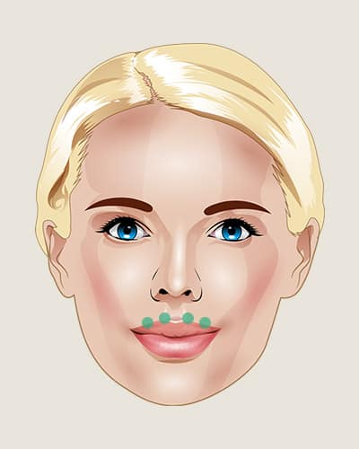 Illustrasjon botox i linjer rundt munnen hos velbehag klinikk