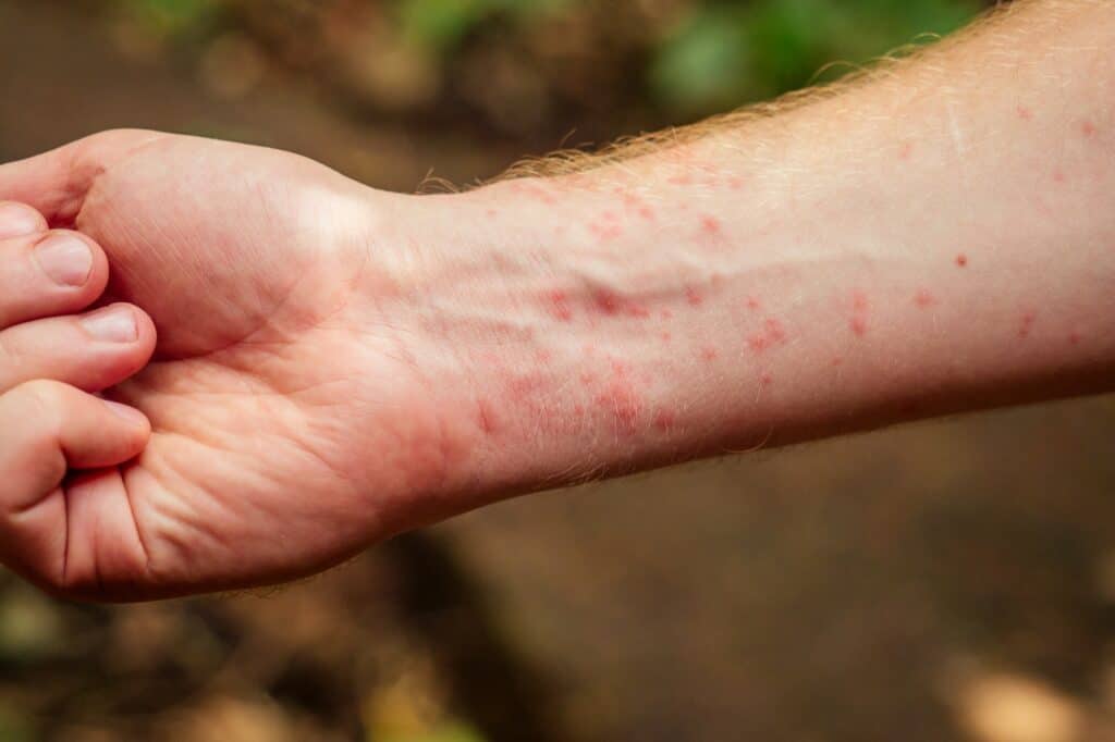 Woman with itching from biting insect in body in tropical jungle forest