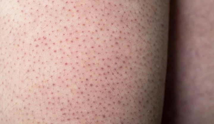 Keratosis pilaris på fremre lår på en ung mann.