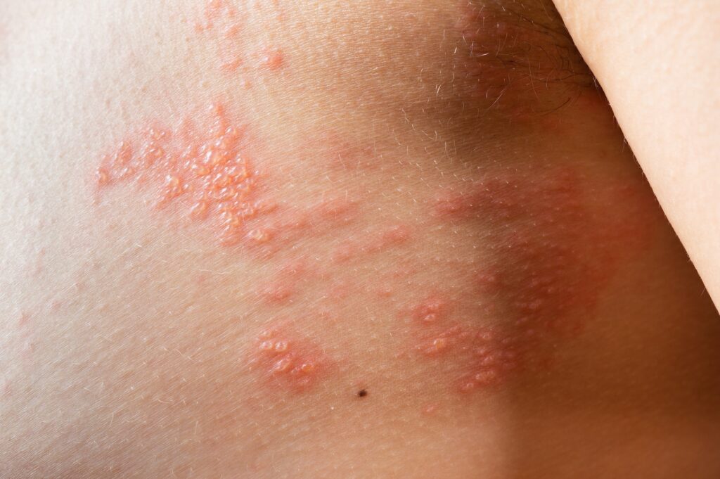 chickenpox rash. Shingles, varicella-zoster virus. skin rash and blisters on body
