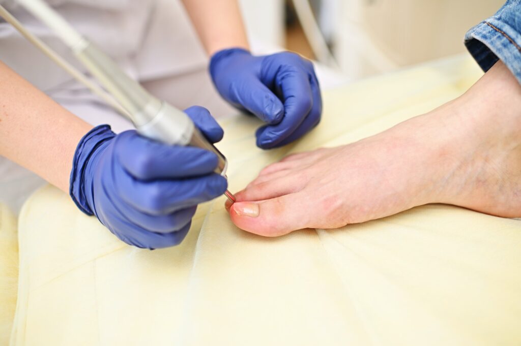 Pedolog bruker en laser for å behandle onykomykose - en soppsykdom i neglene.