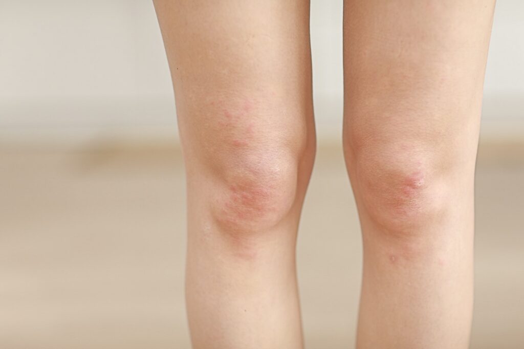 Hvis du utvikler en allergisk reaksjon, vil du sannsynligvis få utslett og ukontrollerbar hudkløe.