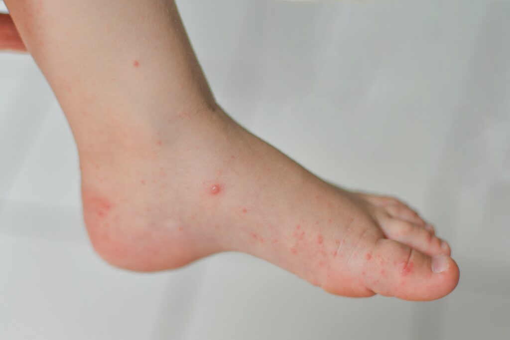 Enterovirus Leg arm mouth Rash on the body of a child Cocksackie virus