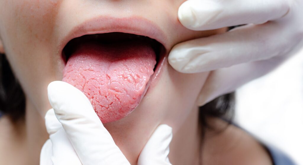 Tongue of a young Caucasian woman with benign migratory glossitis, candidiasis.