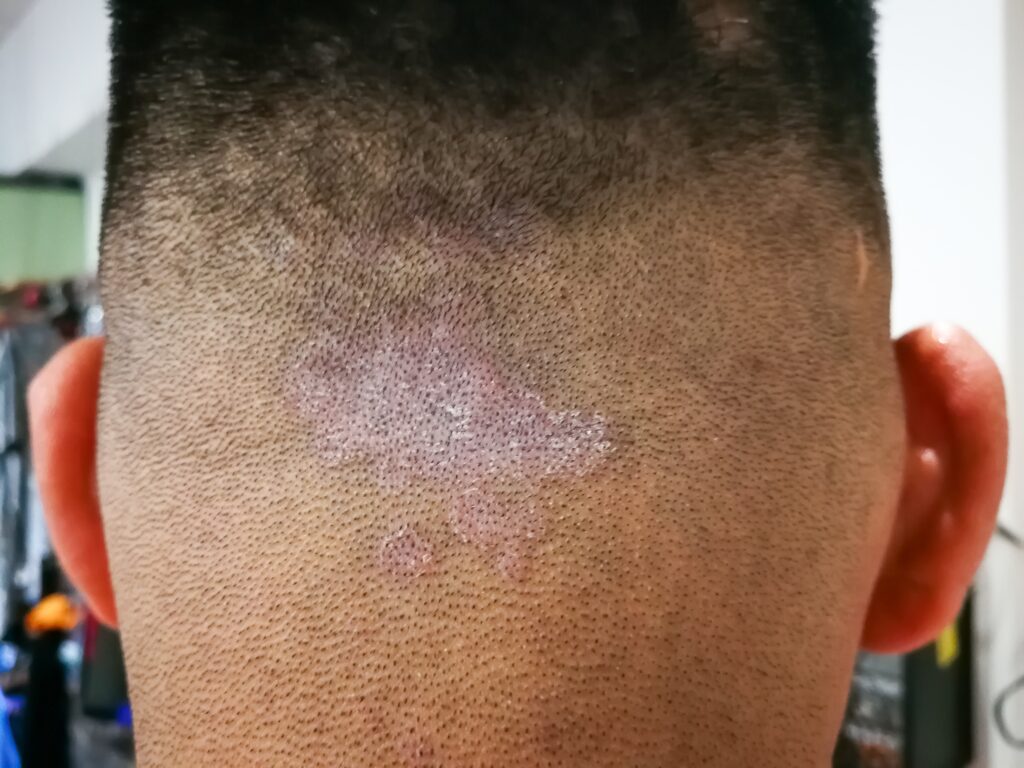 Closed up of ringworm also known as tinea on the scalp of the head. Dermatitis problem.
