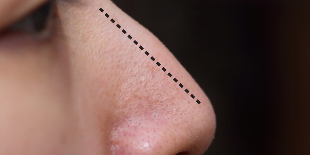 En strek gjennom nesen for å vise at nesen er litt bøyd.
