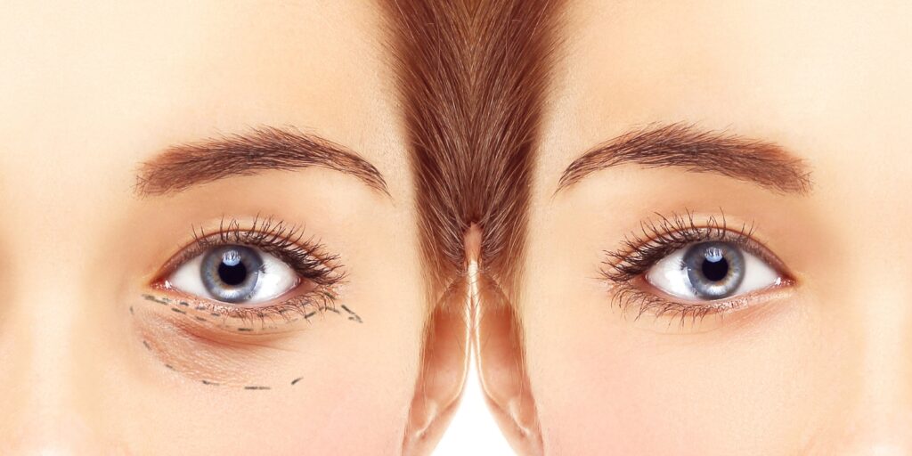 Bilde før og etter øyelokkbehandling.