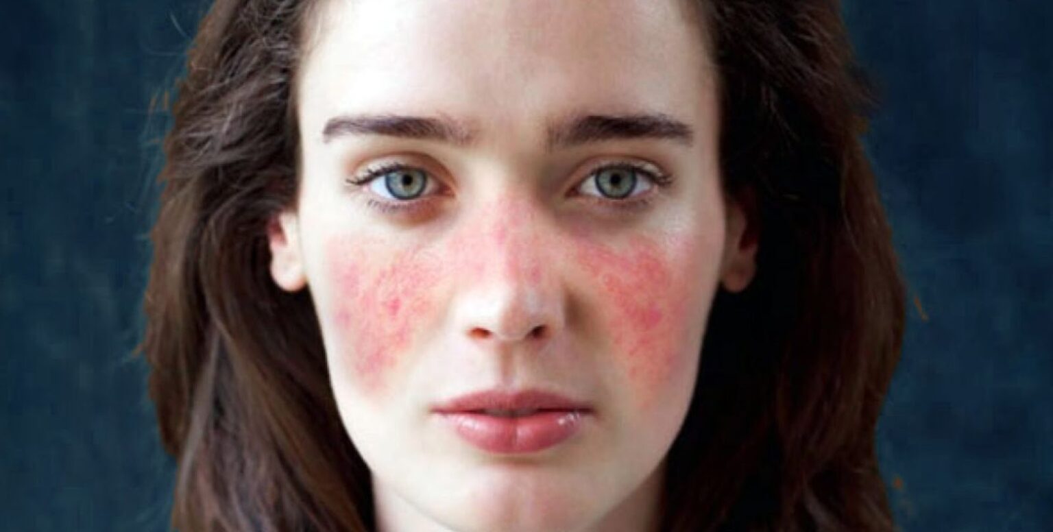 Lupus: Symptomer og behandlinger - Velbehag Medisinsk Hudklinikk