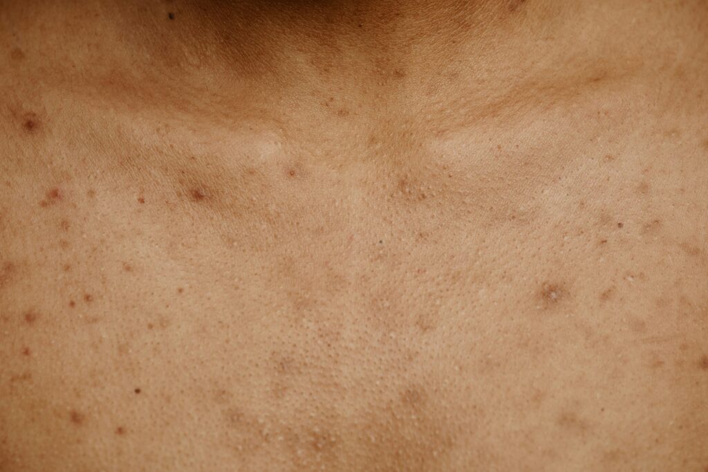 Macro shot of tan skin with acne scar spots and texture