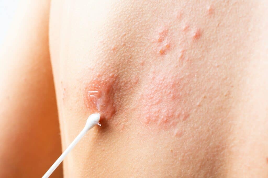 Skin infected Herpes zoster virus. Herpes Virus on body. urticaria rash