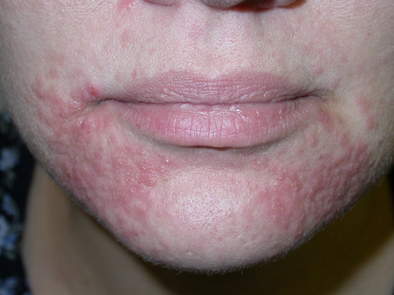Bilde av en person med perioral dermatitt i fjeset