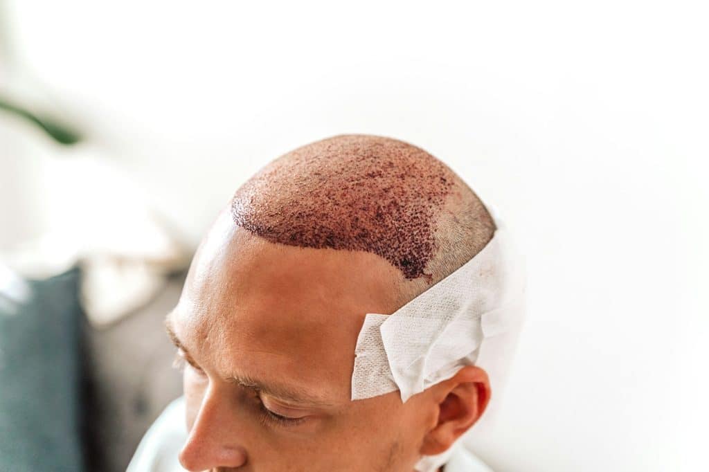 After hair transplantation surgical technique that moves hair follicles. Young bald man in bandage