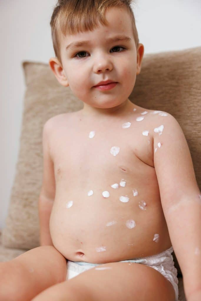 Toddler boy having smallpox